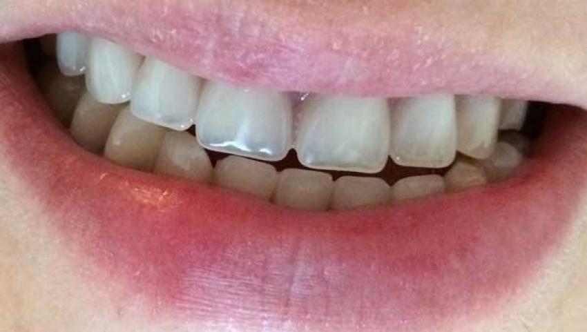  Sağlıklı dişler için neler yapmalı?  