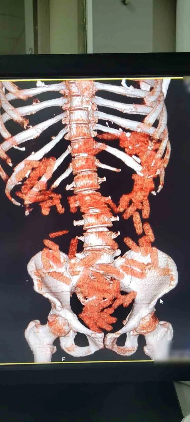 Mide ve bağırsağından uyuşturucu çıktı
