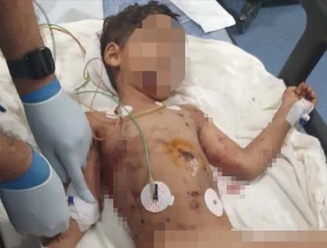 Sokak köpeklerinin saldırdığı 5 yaşındaki Abbas ağır yaralandı
